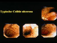 Typische Colitis Ulcerosa